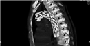 Thoracic Stenting